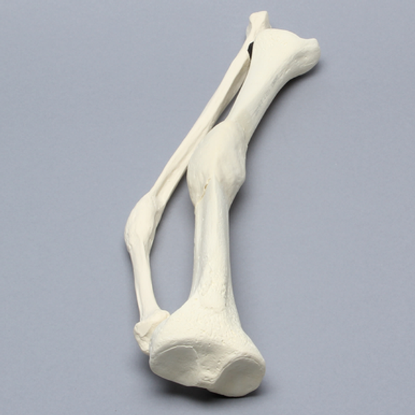 Tibia and Fibula with Malunions and 10º Varus Defect