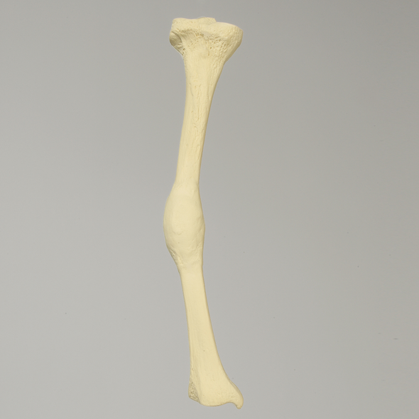 Tibia with Midshaft Malunion and 10º Varus Defect