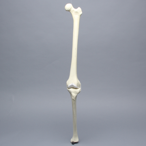 Knee with Erosion and Three Stretch Cord Ligaments, Full Length