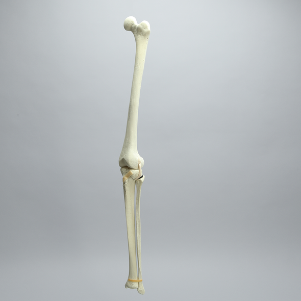 Knee with Unicondylar Fracture and Collateral Ligaments, Full Length