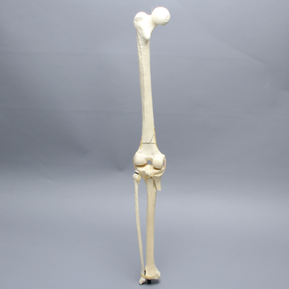 Knee with Femoral Butterfly and Tibial Plateau Fracture, Full Length