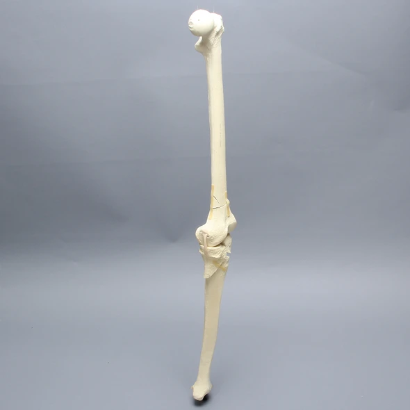 Knee with Femoral Butterfly and Tibial Plateau Fracture, Full Length