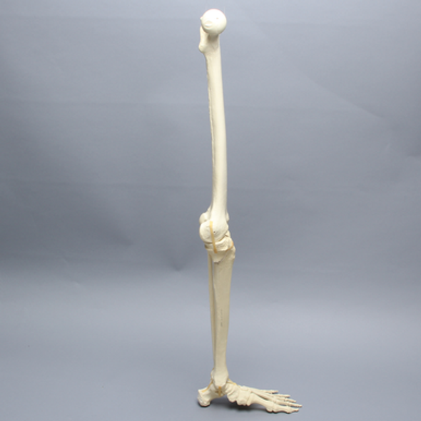 Leg with Plateau Fracture, Full Length