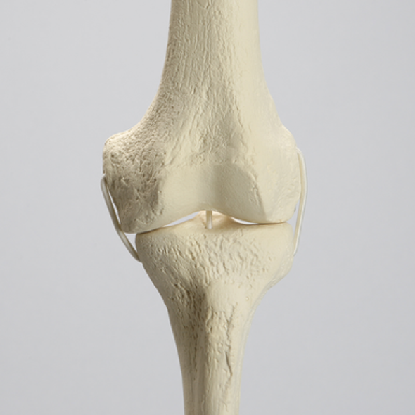 Knee Replacement with Tibia and Femur for #1301-169 and 1301-169-1