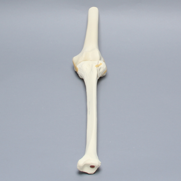 Knee with Plateau Fracture