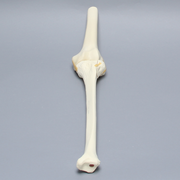 Knee with Plateau Fracture