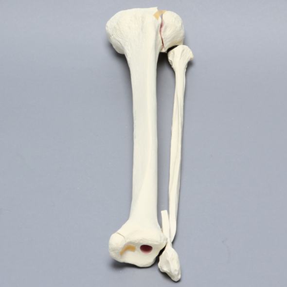 Tibia and Fibula with Condylar, Malleolar, and Oblique Fractures