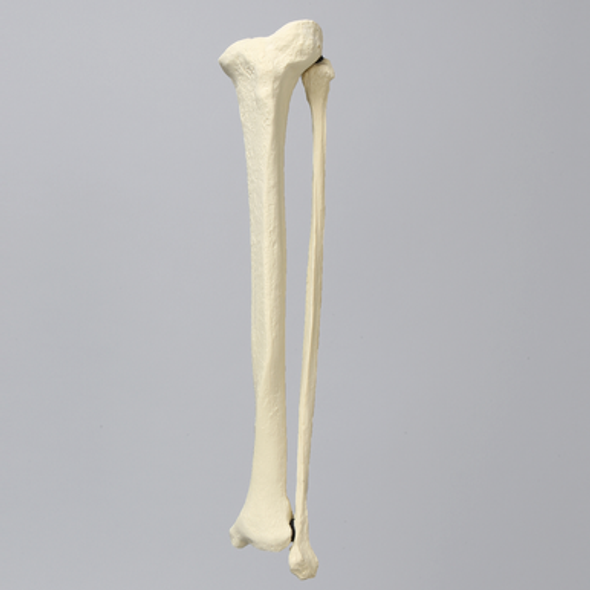 Tibia and Fibula with Blount's Disease