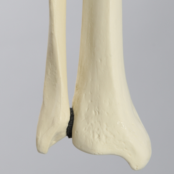 Tibia and Fibula with Fibular Rotation
