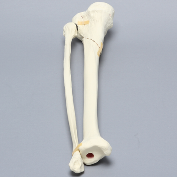Tibia and Fibula with Type Six Tibial Plateau Fracture