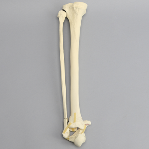 Tibia and Fibula with Pilon and Fractures