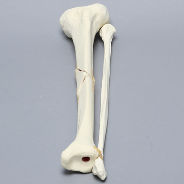 Tibia and Fibula with Butterfly Fracture