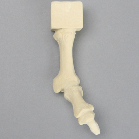 Metatarsal with Hammertoe