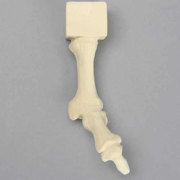 Metatarsal with Hammertoe