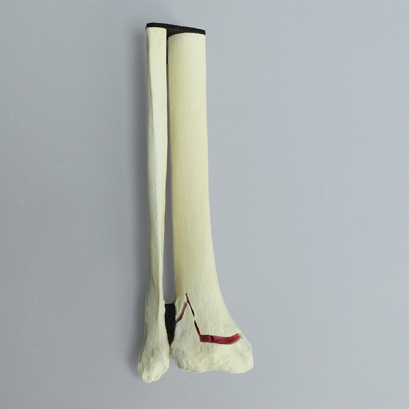 Ankle with Two-Part Triplane Fracture, Pediatric