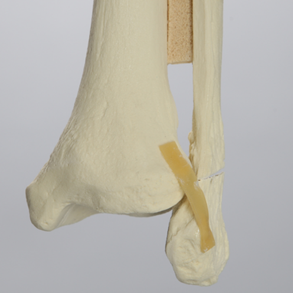 Ankle with Displaced Oblique Fracture