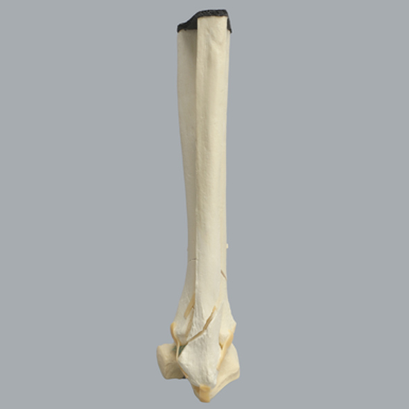 Ankle with Pilon and Oblique Fractures
