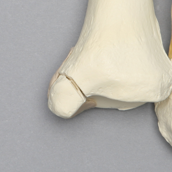 Ankle with Medial and Posterior Malleolar, and Oblique Fibular Fractures