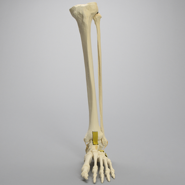 Foot and Ankle with Three-Part Calcaneal Fracture