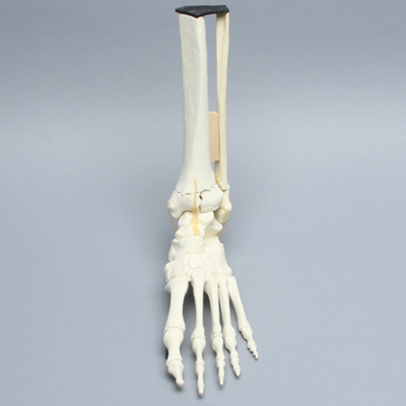 Foot and Ankle with Tibial Three-Part Pilon and Fibular Oblique Fractures