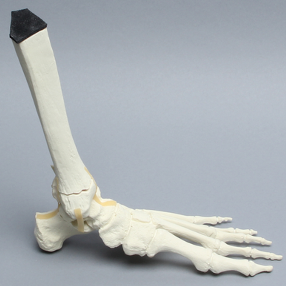 Foot and Ankle with Tibial Three-Part Pilon and Fibular Oblique Fractures
