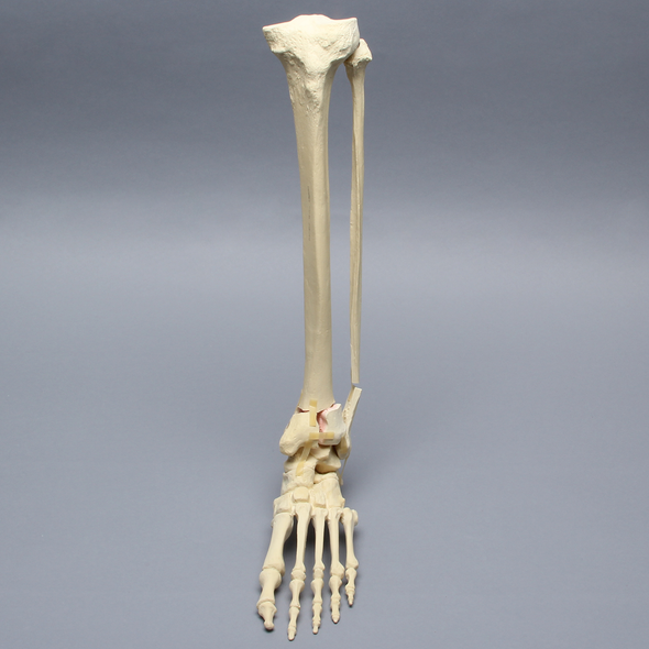 Foot and Ankle with Articulation and Tibial Pilon and Transverse Fibular Fractures