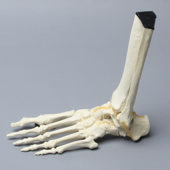 Foot and Ankle with Calcaneal Fracture
