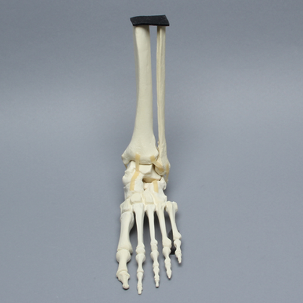 Foot and Ankle with Arthritis and Calcaneal Malunion