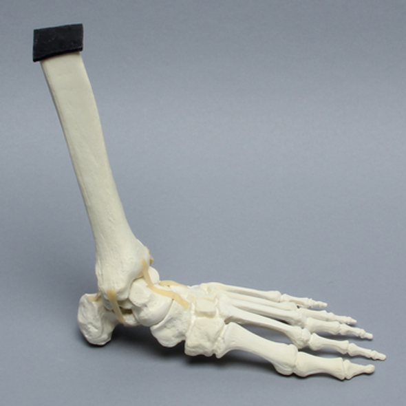 Foot and Ankle with Arthritis and Calcaneal Malunion