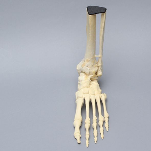 Foot and Ankle with Tibial Pilon and Fibular Oblique Fractures and Talar Rotation