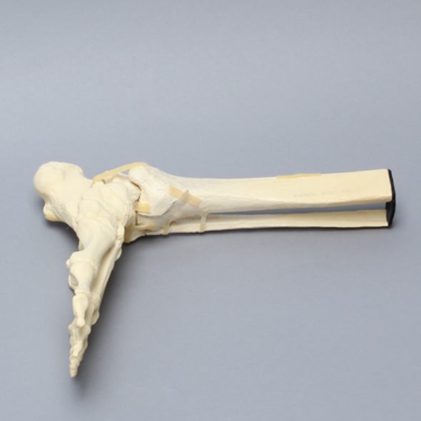 Foot and Ankle with Tibial Pilon and Fibular Oblique Fractures and Talar Rotation