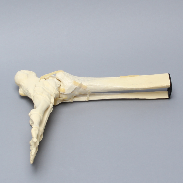 Foot and Ankle with Tibial Pilon and Fibular Oblique Fractures and Talar Rotation