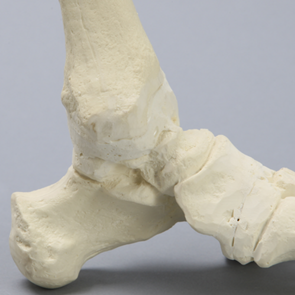 Foot and Ankle with Fusion, Abduction, and Equinus Deformities