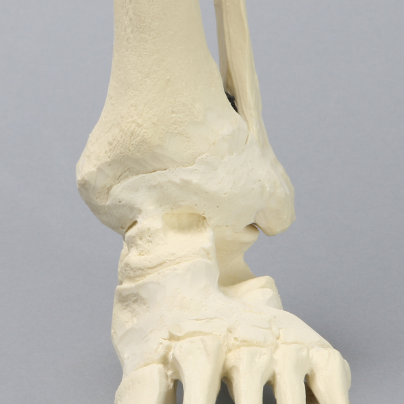 Foot and Ankle with Fusion, Abduction, and Equinus Deformities