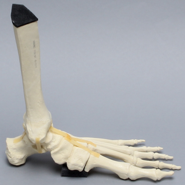 Foot and Ankle with Lisfranc Fracture