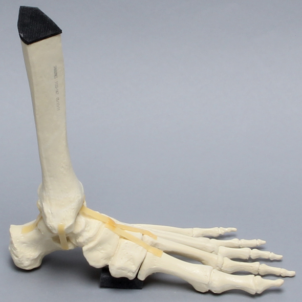 Foot and Ankle with Lisfranc Fracture