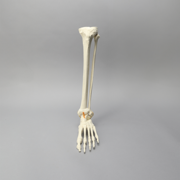 Foot and Ankle with Malunion and Valgus Deformity