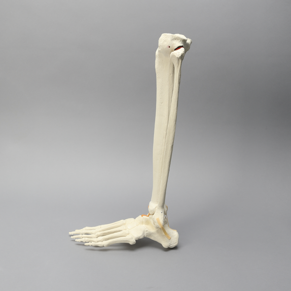 Foot and Ankle with Malunion and Valgus Deformity