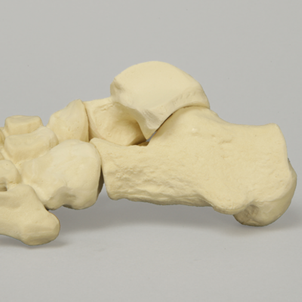 Foot with Flatfoot Condition