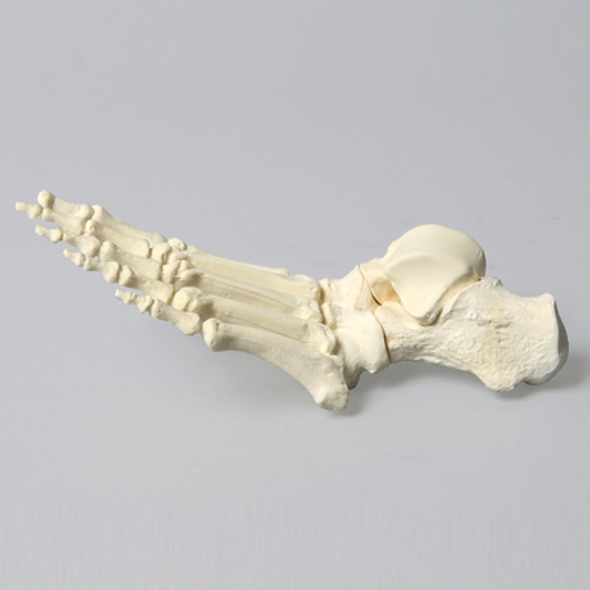 Foot with Rocker Bottom Deformity