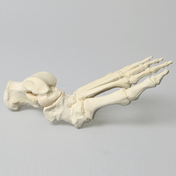 Foot with Rocker Bottom Deformity