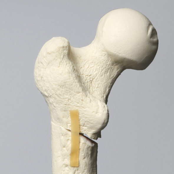 Femur with Subtrochanteric Oblique Fracture