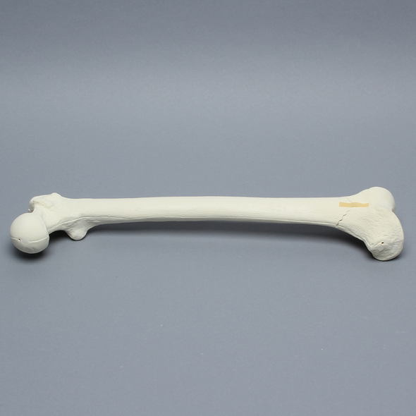 Femur with Supracondylar Fracture