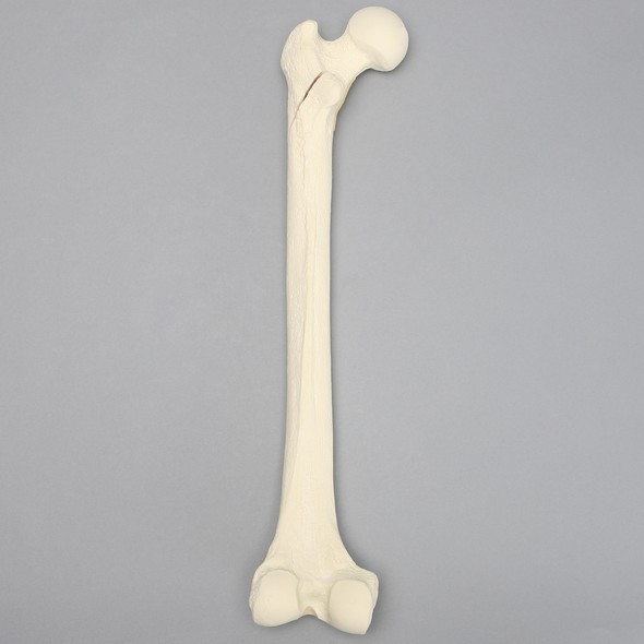 Femur with Subtrochanteric Spiral Fracture