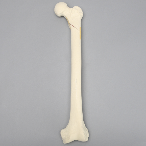 Femur with Subtrochanteric Spiral Fracture