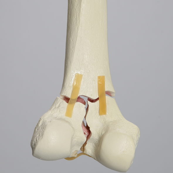 Femur with "T" Fracture