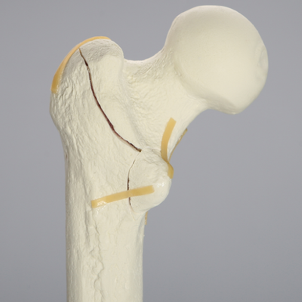Femur with Intertrochanteric Fracture with Fragment
