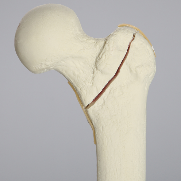 Femur with Intertrochanteric Fracture with Fragment