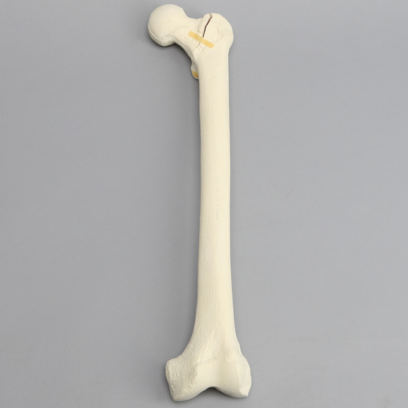 Femur with Three-Part Fracture