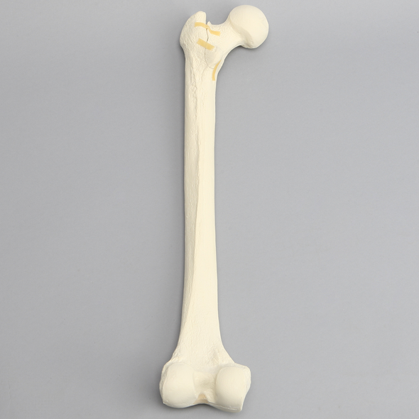 Femur with Three-Part Fracture